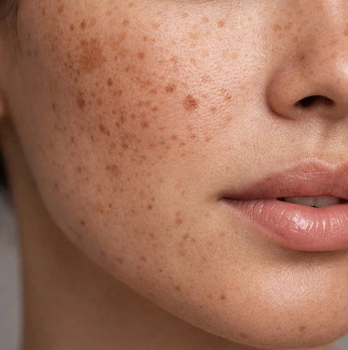 Acne & pimples